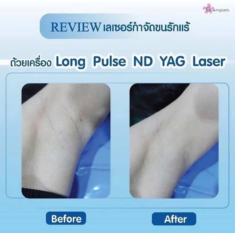รีวิว-เลเซอร์รักแร้ขาว-YAG-Laser