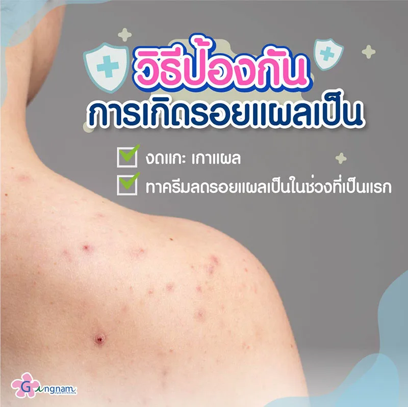 การดูแลรอยแผลเป็นให้หายเร็ว
