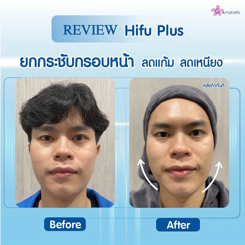 รีวิว hifu ยกกระชับกรอบหน้า