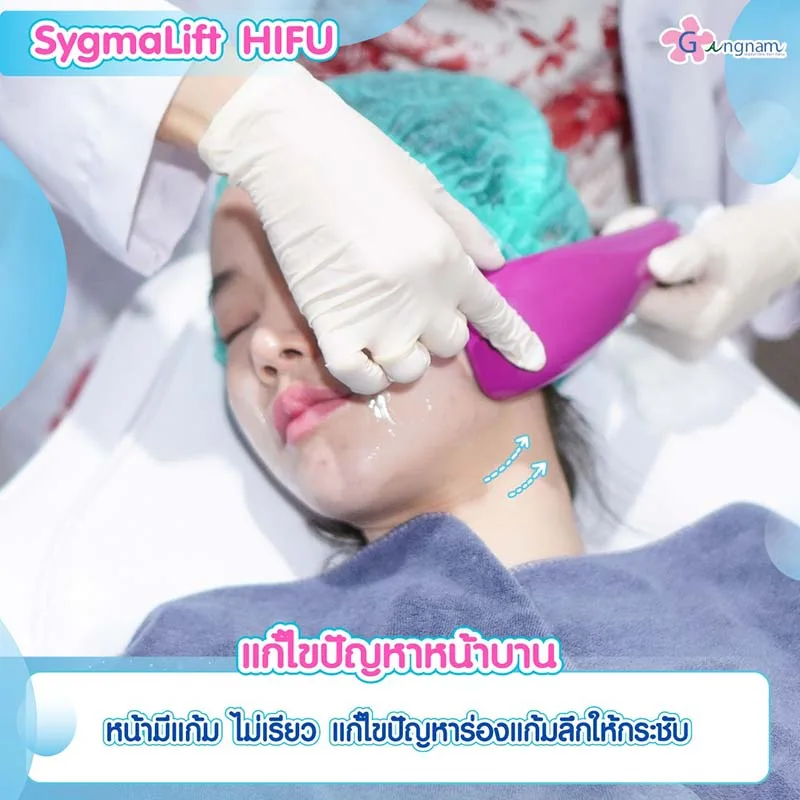 Sygmalift Hifu แก้ปัญหาหน้าบาน สำหรับคนมีแก้ม