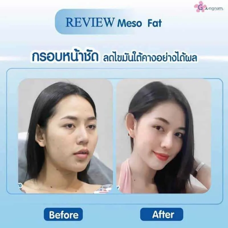 การฉีดเมโสแฟต ข้อดี ข้อเสีย ในปัจจุบัน_01