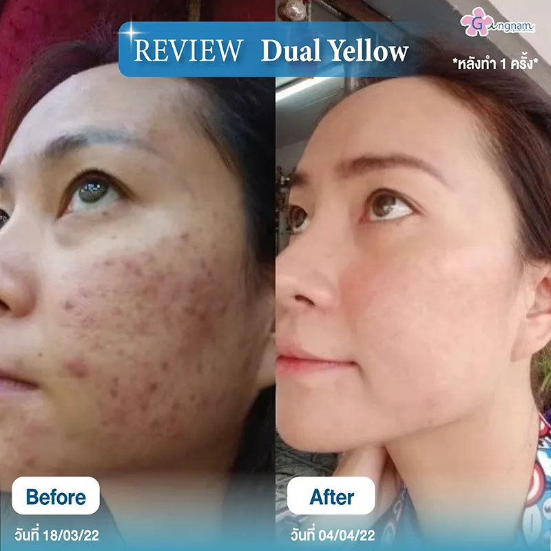 รีวิวเลเซอร์รอยสิวครั้งแรก