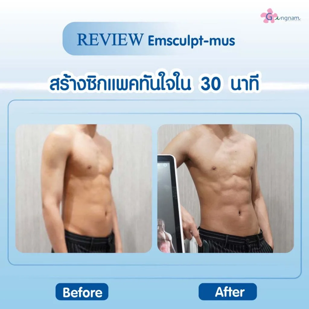 Emsculpt mus รีวิว