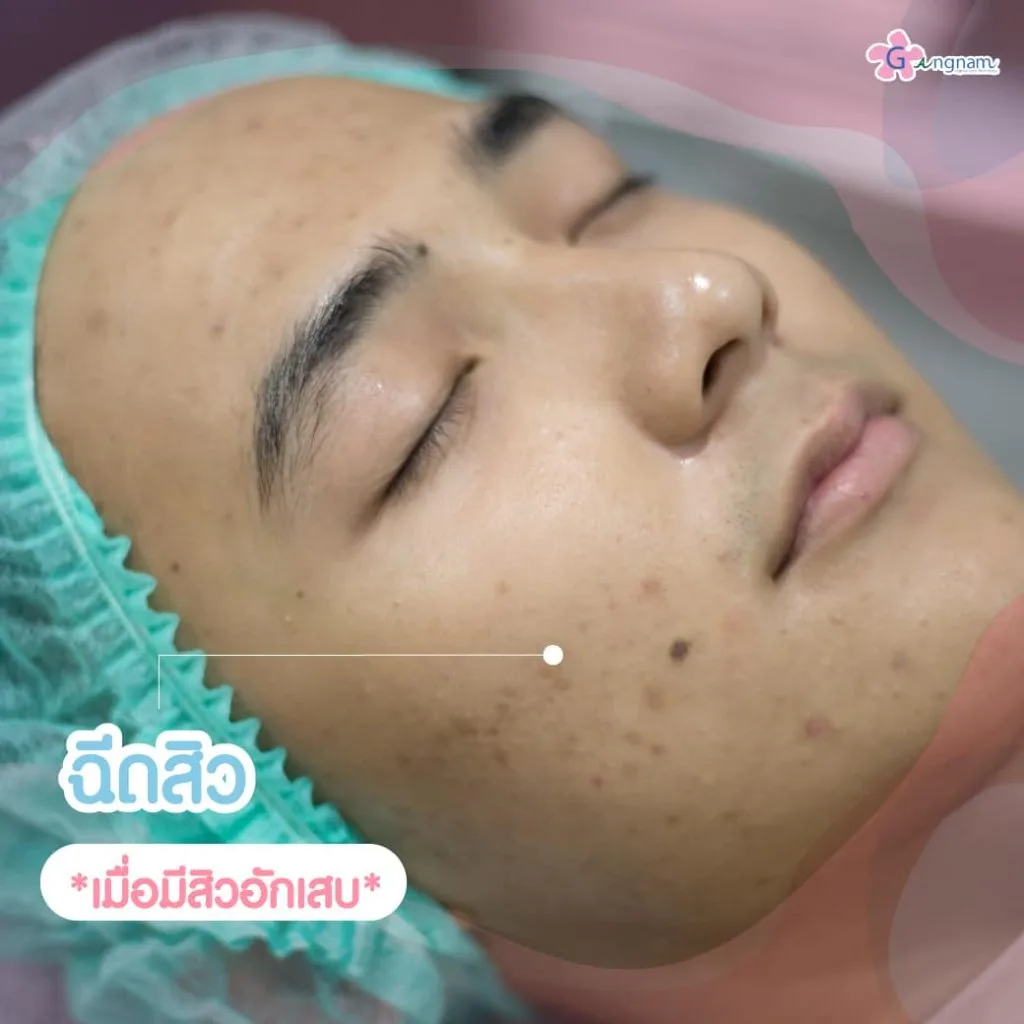 ฉีดสิว