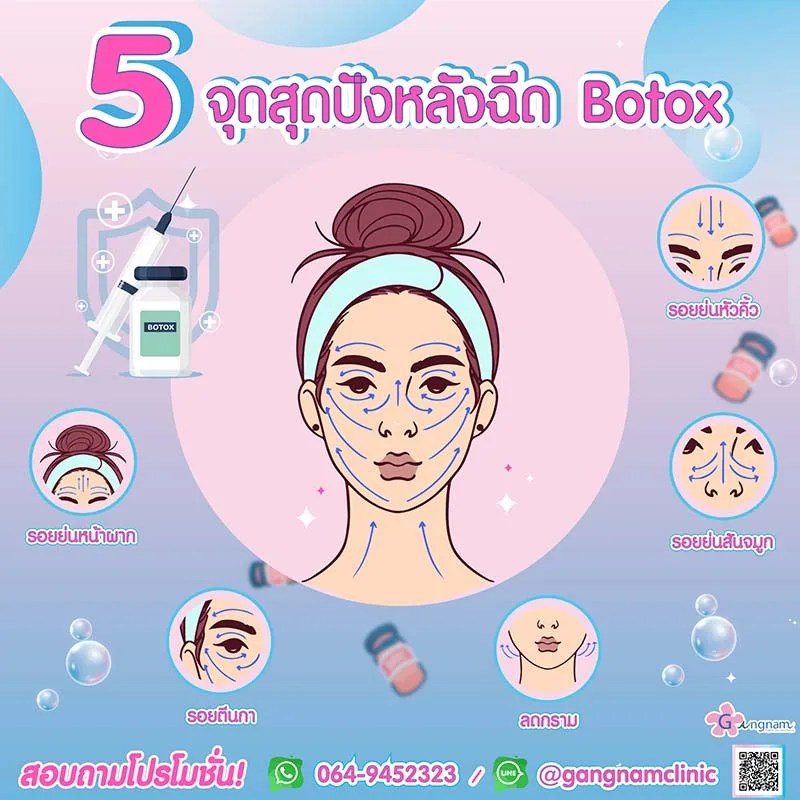 ตำแหน่งที่นิยมฉีดโบท็อก