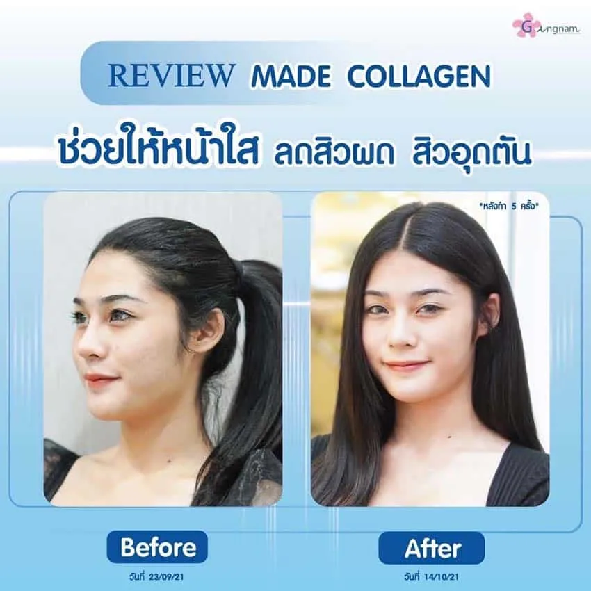 MADE Collagen ช่วยให้หน้าใส ลดสิวผด สิวอุดตัน
