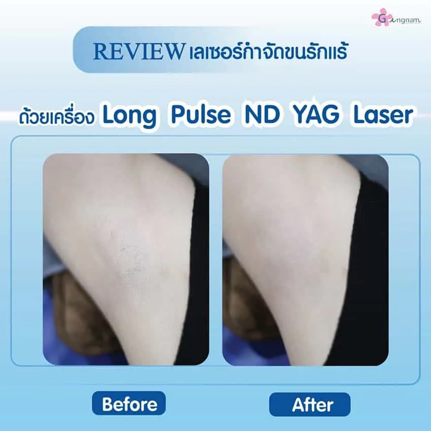 รีวิวเลเซอร์รักแร้ Long Pulse ND Yag