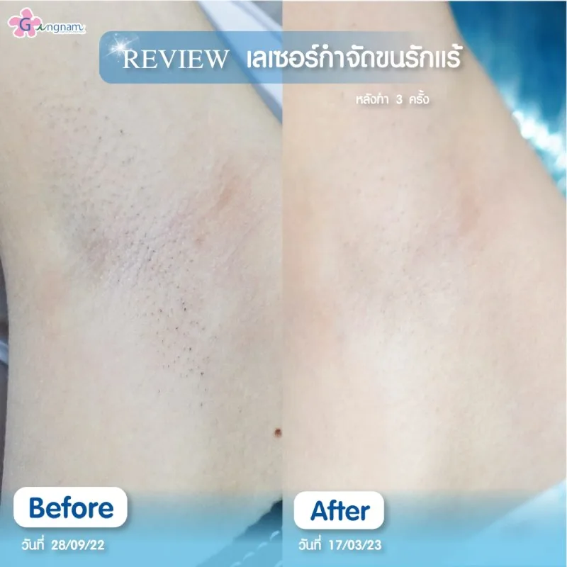 เลเซอร์ขนรักแร้
