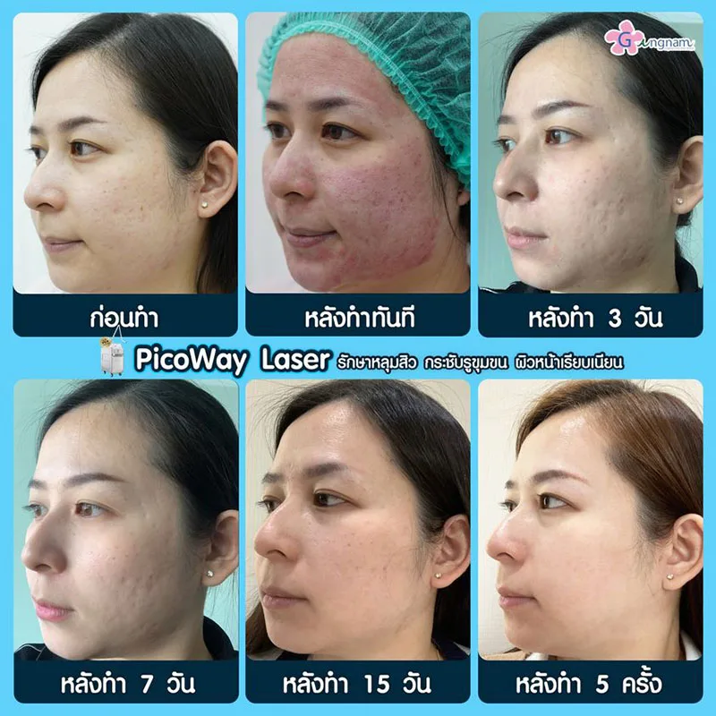 รีวิวเลเซอร์รักษาหลุมสิว ผู้หญิง