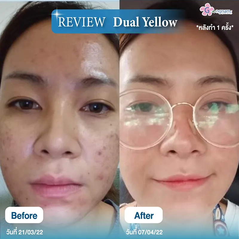 รีวิวเลเซอร์ลดรอยดำ รอยแดง