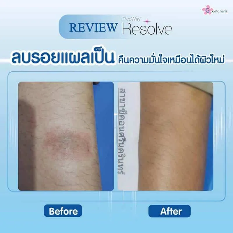 รีวิวเลเซอร์รอยแผลเป็น รอยท่อไอเสีย