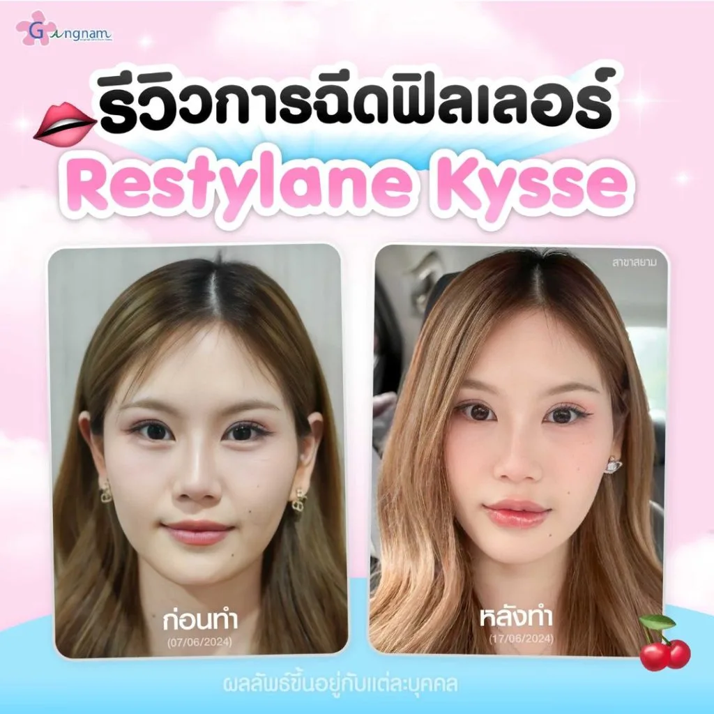 รีวิวการฉีดฟิลเลอร์ restylane kysse 1