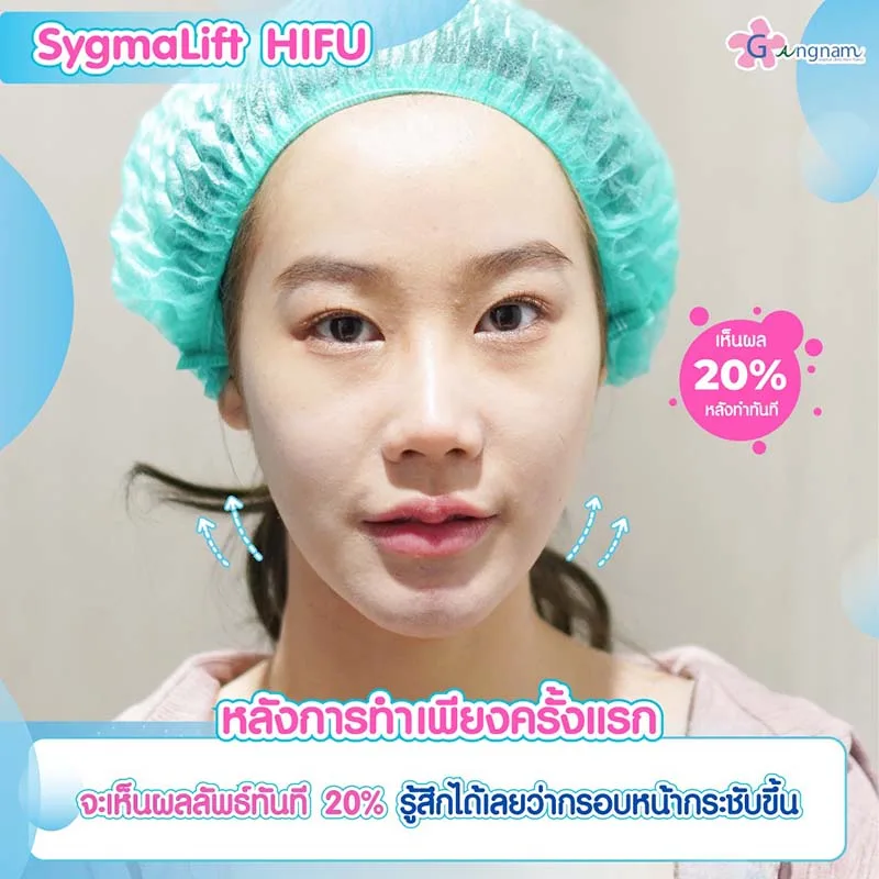 Sygmalift Hifu กี่ครั้งเห็นผล