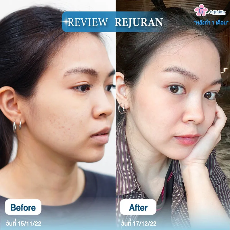 ฉีด rejuran ให้ผิวเงาใส แบบ Glass skin