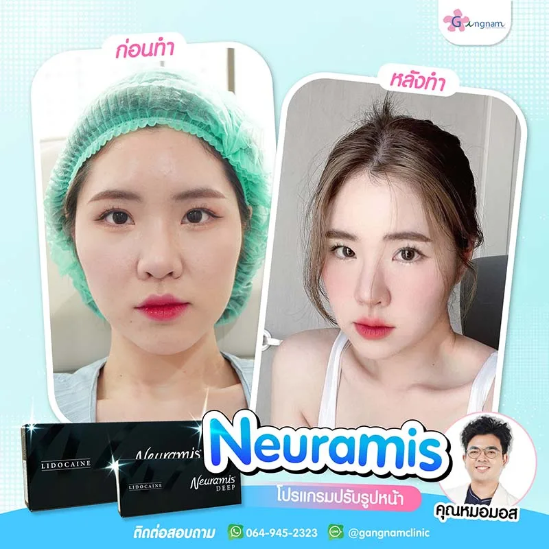 ผลลัพธ์ก่อนและหลังฉีดฟิลเลอร์ neuramis
