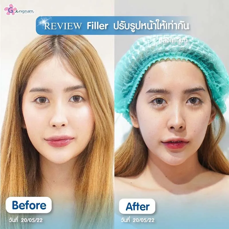 ฉีดฟิลเลอร์ปรับรูปหน้าให้เท่ากัน