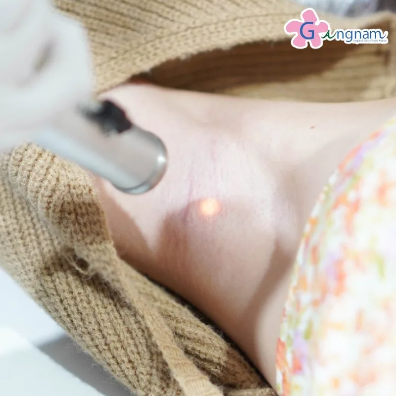 Long Pulse ND Yag laser รักแร้ผิวหนังไก่