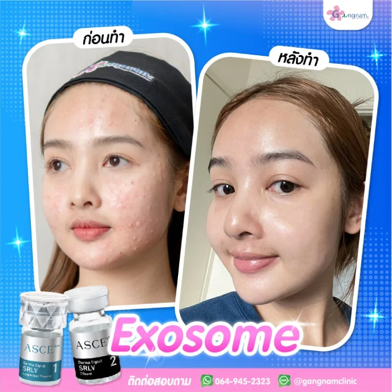 รีวิวผลลัพธ์หลังฉีด exosome