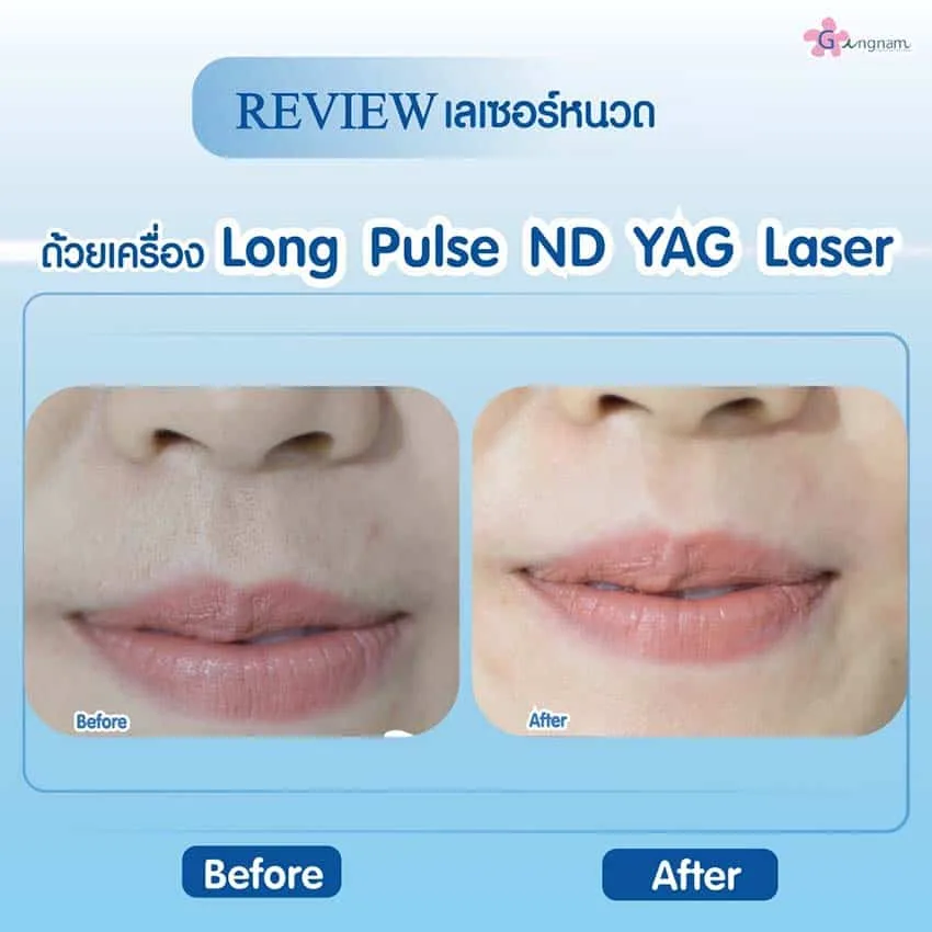 เจาะลึก Long Pulse Nd Yag Laser คืออะไร เหมาะกับใคร ใช้กำจัดขนจุดไหนบ้าง?
