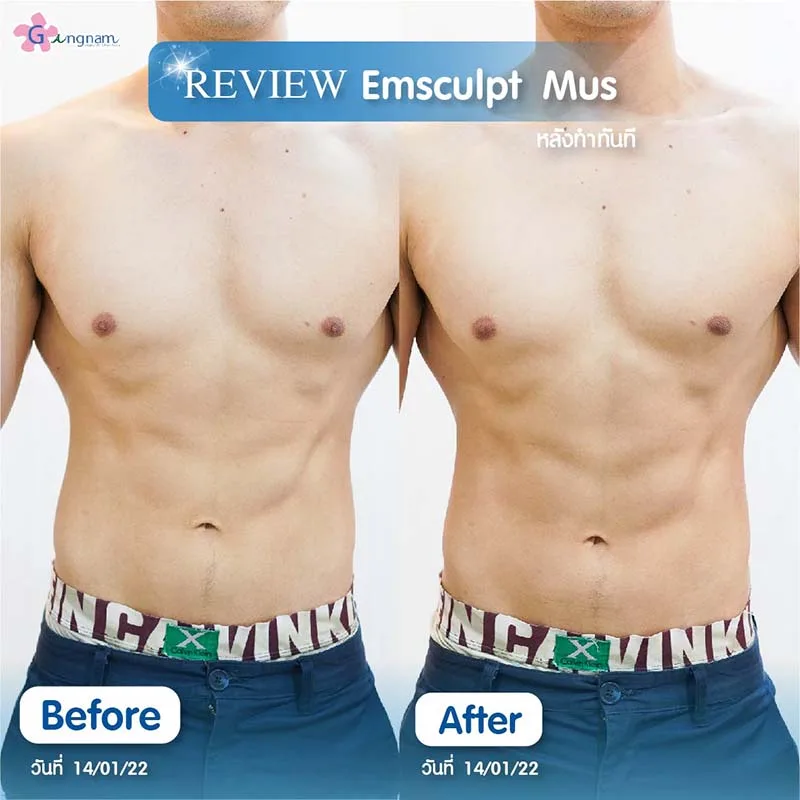 สร้างซิกแพค แบบเร่งด่วน ด้วย Sculpt-Mus คืออะไร? กี่ครั้งเห็นผล ได้ผลจริงไหม?