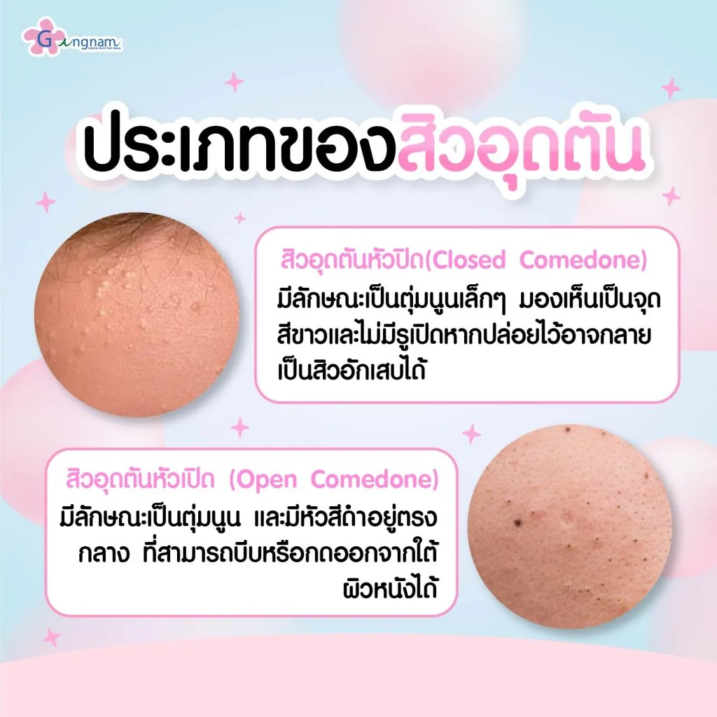 ประเภทของสิวอุดตัน