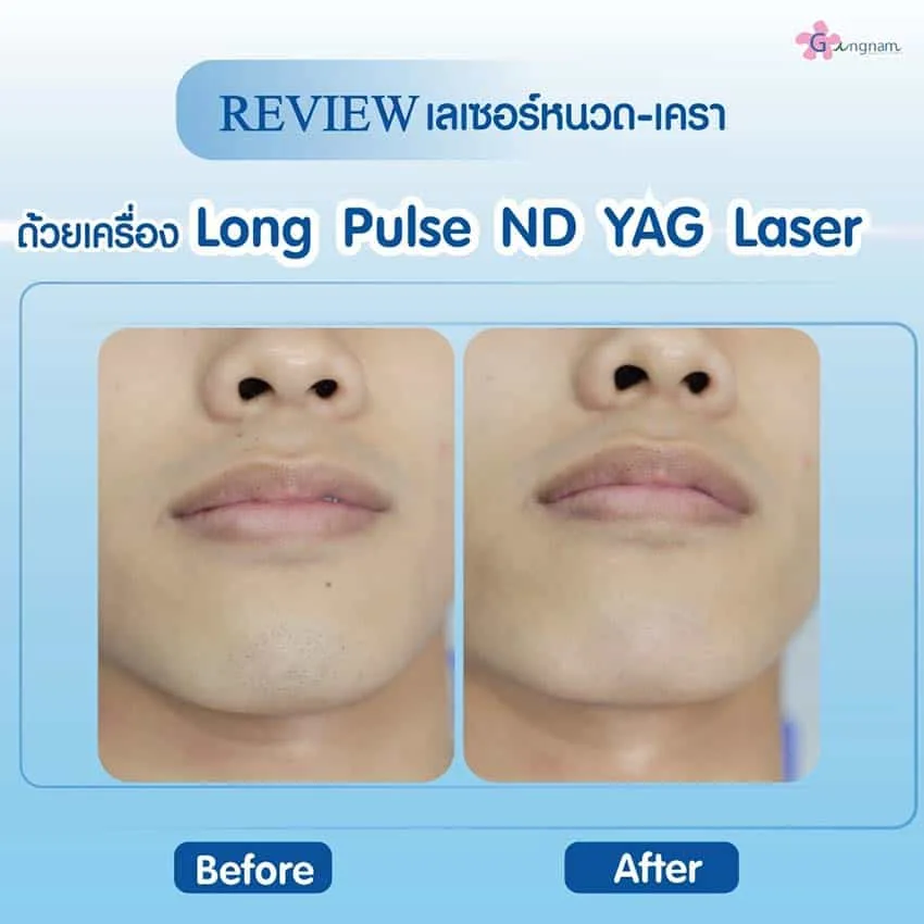 เจาะลึก Long Pulse Nd Yag Laser คืออะไร เหมาะกับใคร ใช้กำจัดขนจุดไหนบ้าง?