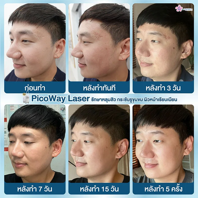 จำนวนครั้งหลังทำเลเซอร์หลุมสิว