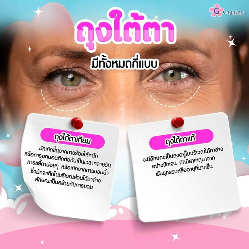 ถุงใต้ตามีกี่แบบ