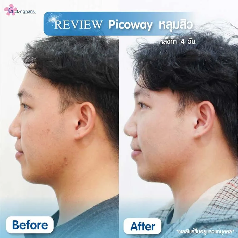 pico laser รักษาสิวที่คาง