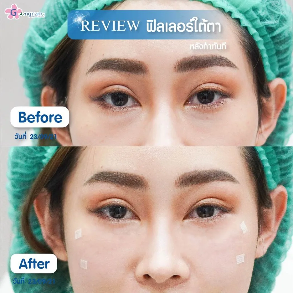 ฉีดฟิลเลอร์ลดริ้วรอยใต้ตา
