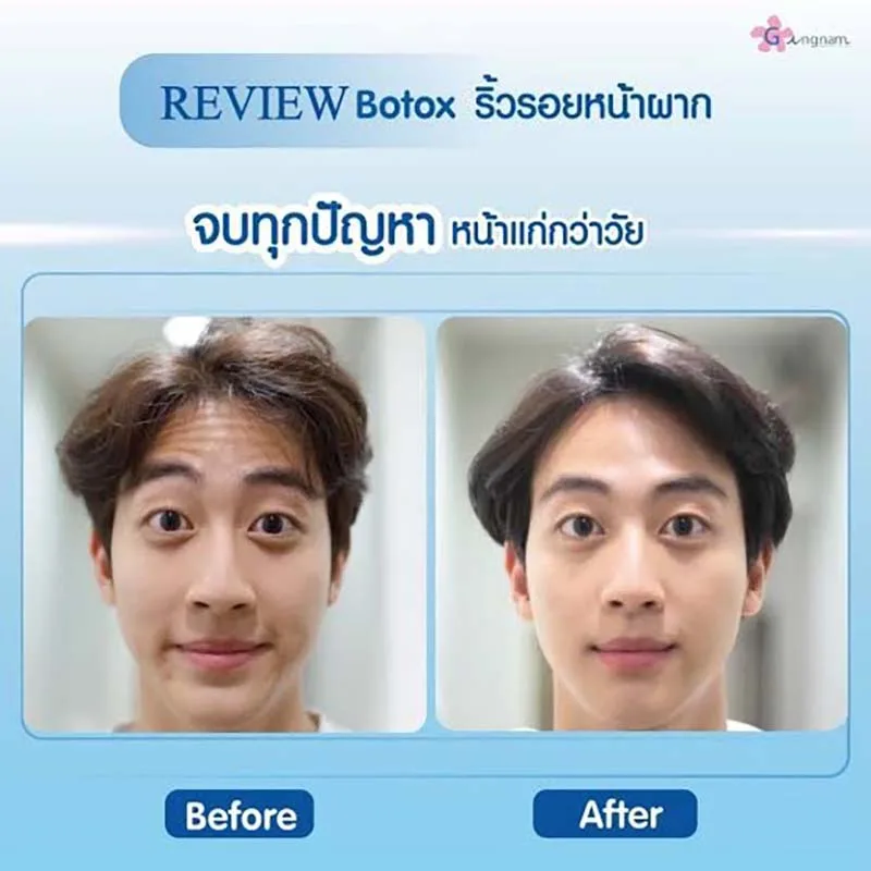 Botox ลดริ้วรอยหน้าผาก