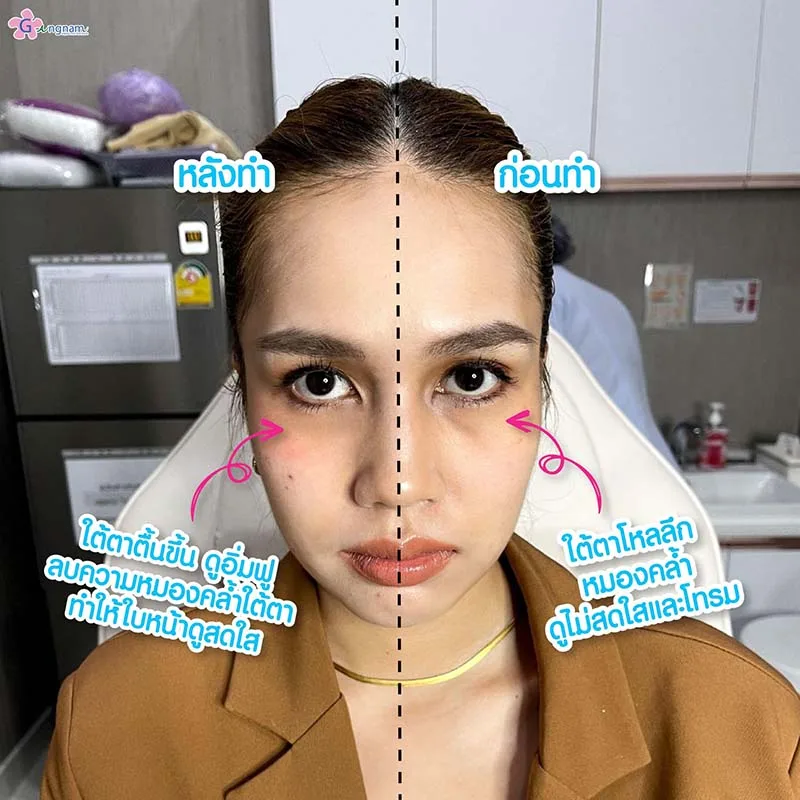 ก่อน-หลังฉีดฟิลเลอร์ แก้ตาโหล เบ้าตาลึก