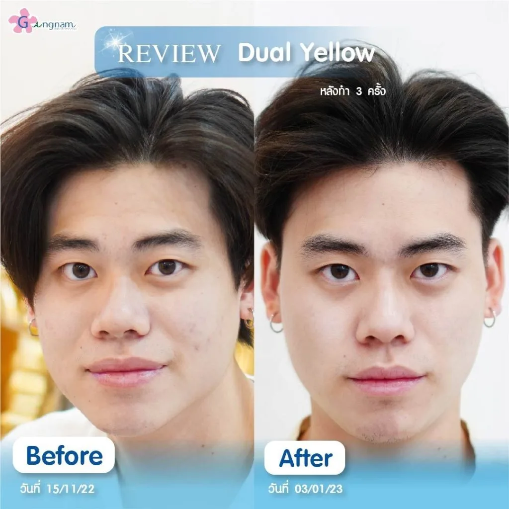 หลังทำ dual yellow laser 3 ครั้ง