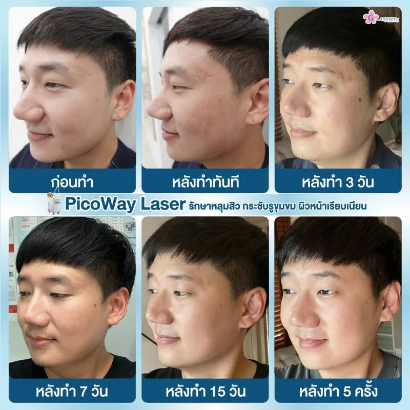 รักษาหลุมสิวด้วย Picoway Laser 2