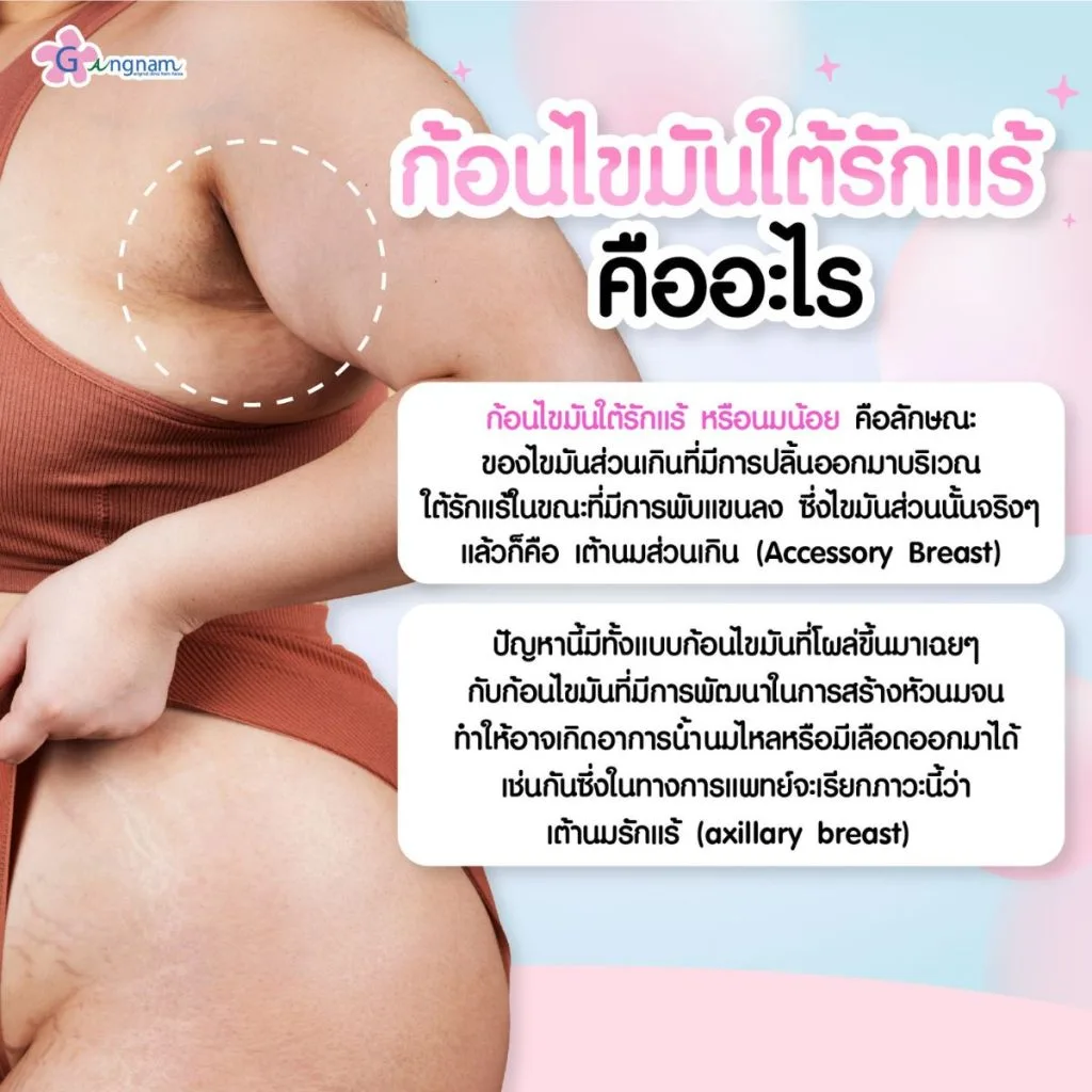 ก้อนไขมันใต้รักแร้ คืออะไร