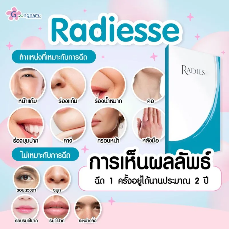 การเห็นผลของ Radiesse และตำแหน่งที่เหมาะกับการฉีด