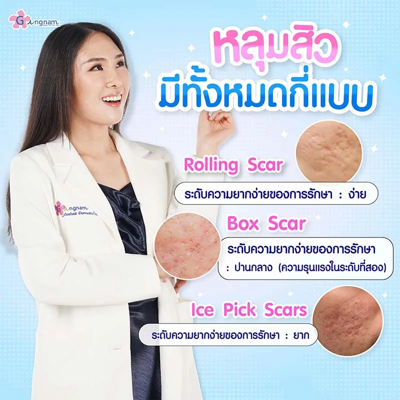 หลุมสิว มีทั้งหมดกี่แบบ ต่างกันอย่างไร