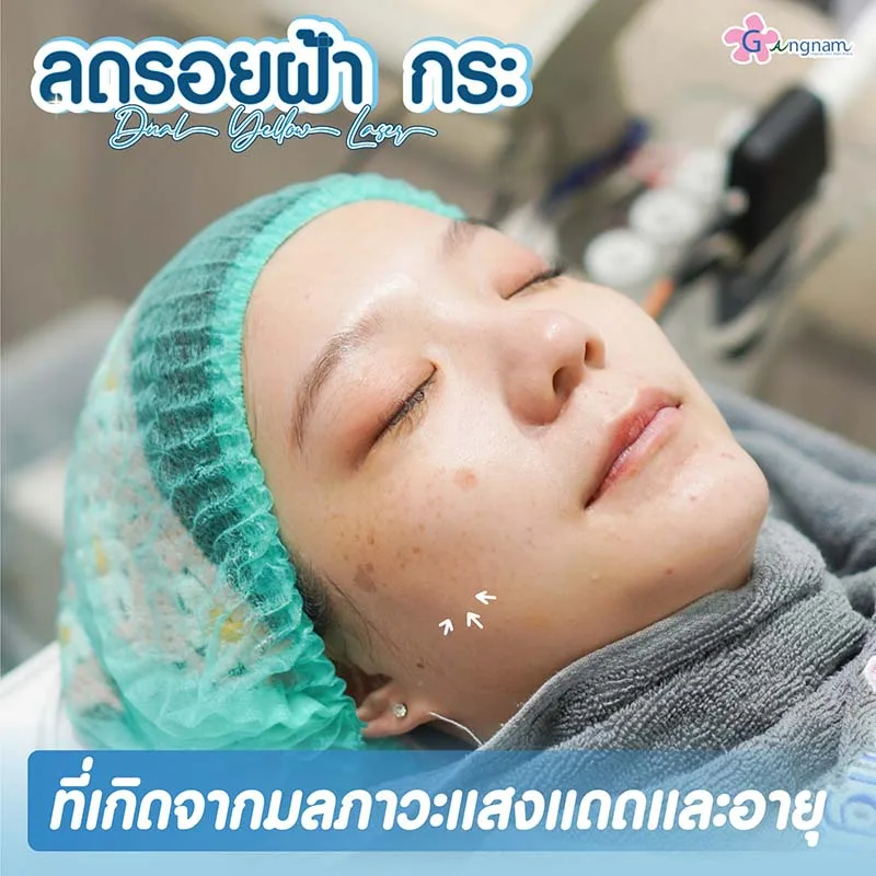 Dual Yellow ลดรอยกระ และฝ้า