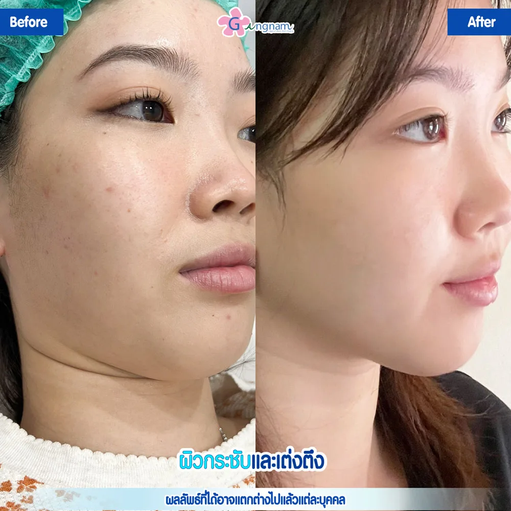 หลังฉีด Chanel injection ผิวหน้าเต่งตึงขึ้น