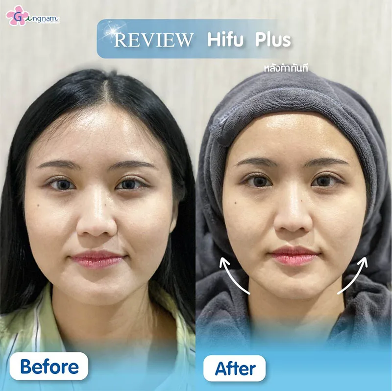 รีวิว hifu plus