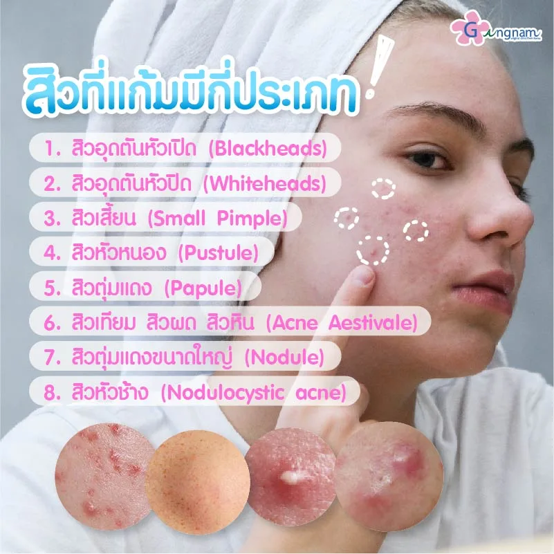 สิวที่แก้มมีกี่ประเภท
