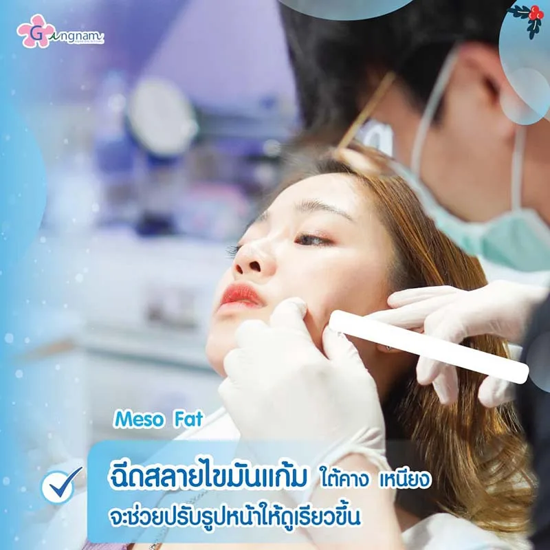 ฉีดเมโสแฟตสลายไขมันที่แก้ม