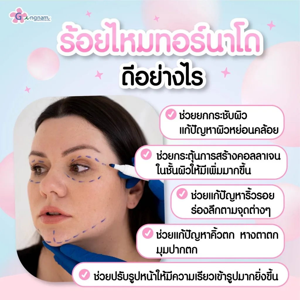 ร้อยไหมทอร์นาโดดีอย่างไร