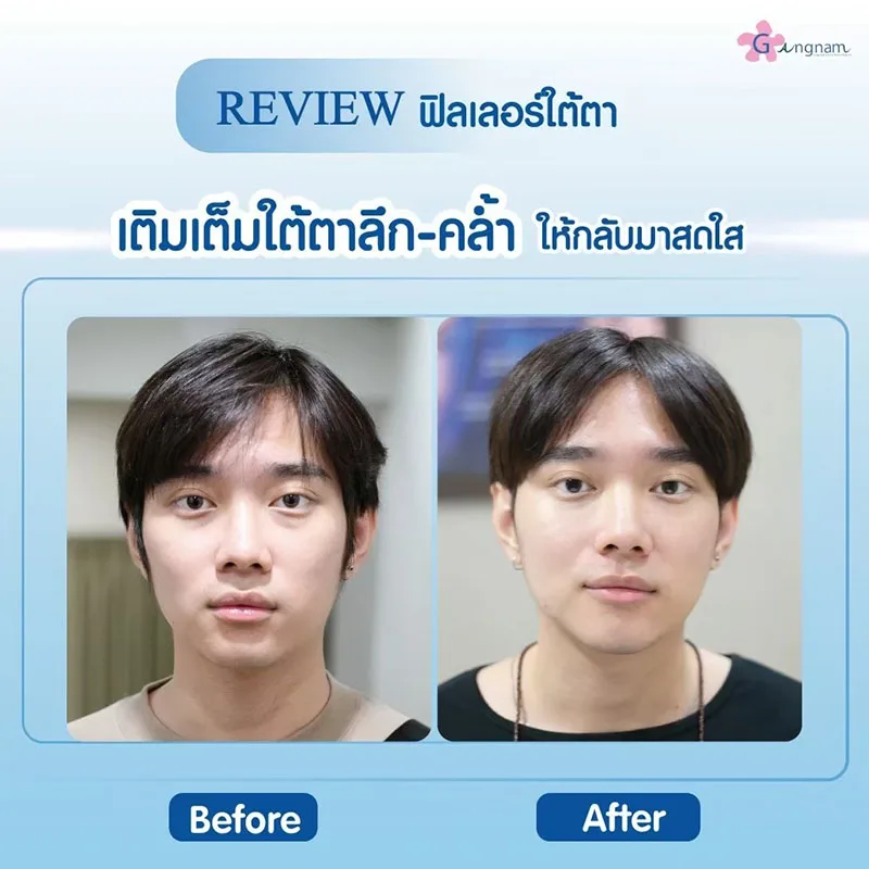 ฉีดฟิลเลอร์ แก้ถุงใต้ตา