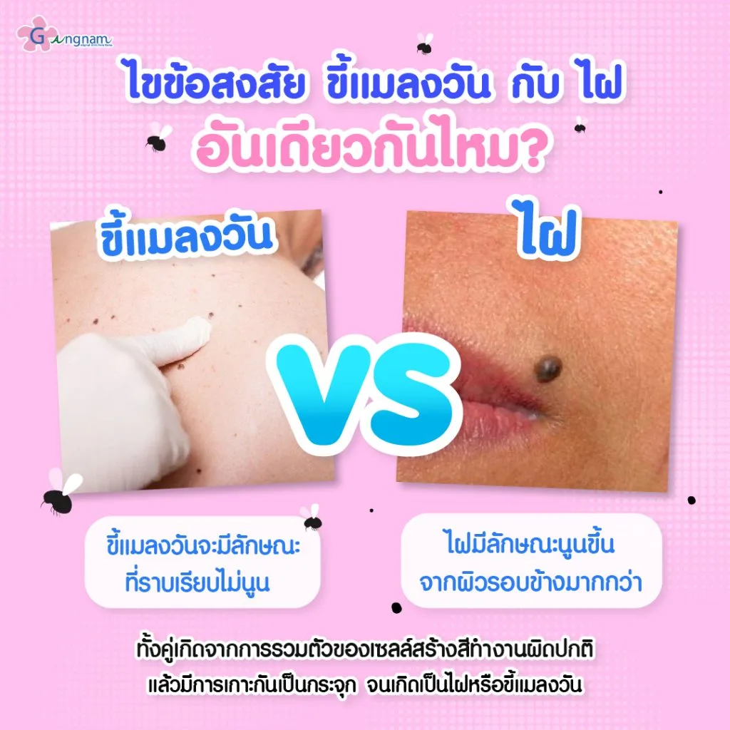 ขี้แมลงวัน กับ ไฝเหมือนหรือต่างกันอย่างไร