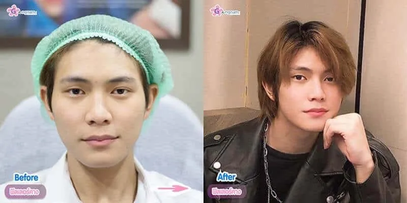 ฉีดฟิลเลอร์คาง อันตรายไหม อยากคางสวยปลอดภัย ไม่เป็นก้อน ควรรู้อะไรบ้าง