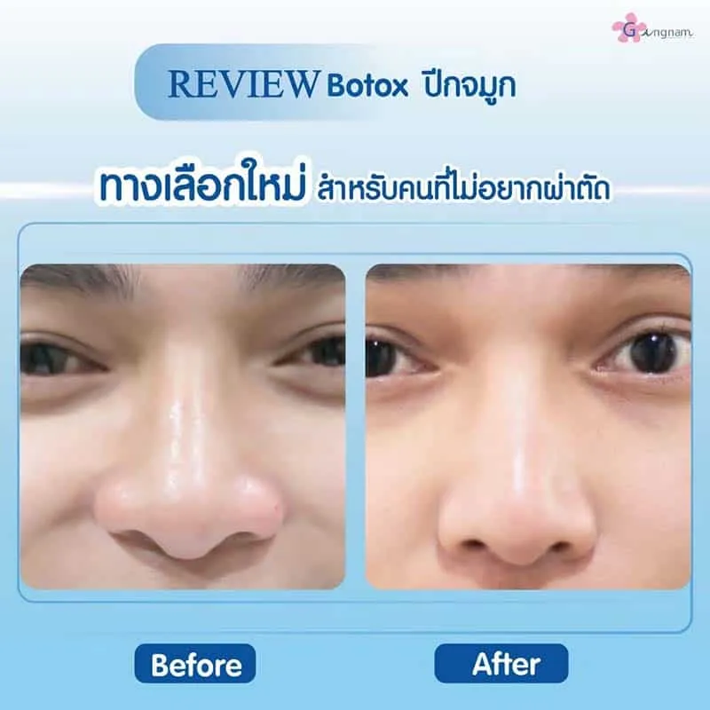 รีวิวโบท็อกปีกจมูก