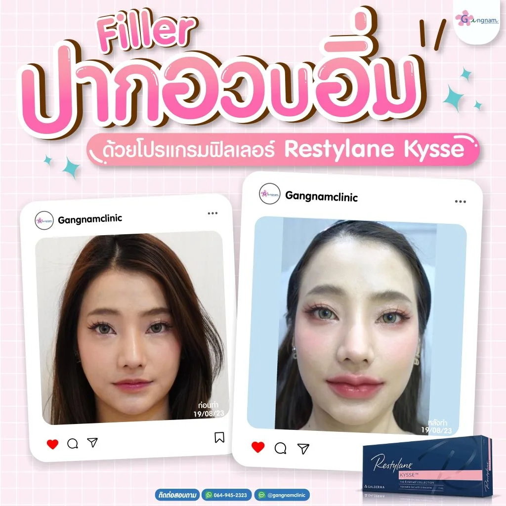 ฉีดปากกระจับฟิลเลอร์แท้