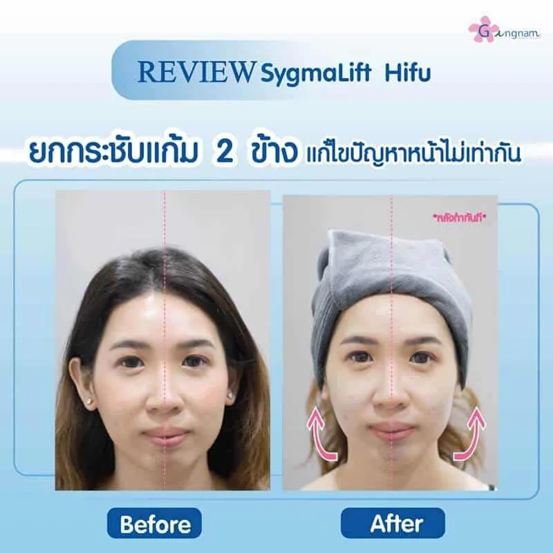 รีวิว Sygmalift Hifu ยกกระชับหน้าไม่เท่ากัน