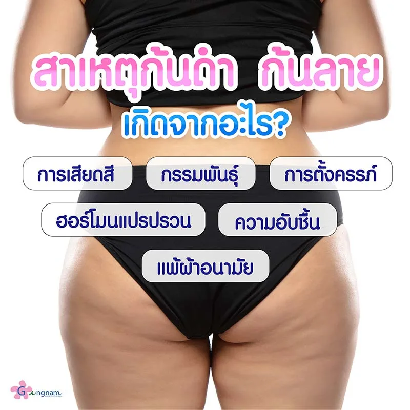 สาเหตุก้นดำ ก้นลาย เกิดจากอะไร